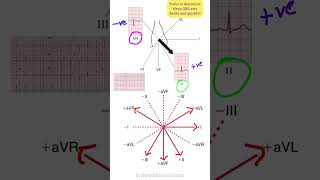 Cardiac Axis Determination: Quick & easiest tricks. #medicalstudent #mbbs #ecganalysis #heartbeat