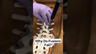 Why Do Disc Fusions Fail?