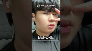 Facial Contouring, Eye Surgery, Nose Surgery Transformation #shorts
