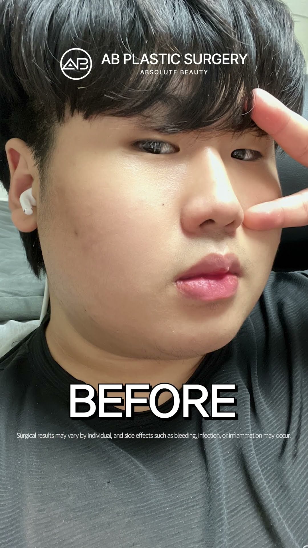 Facial Contouring, Eye Surgery, Nose Surgery Transformation #shorts