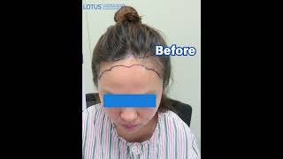 Women’s No-Shave Hair Transplant | 1800 Grafts Hairline Before &amp; After
