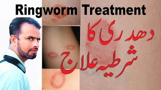 tadri ka ilaj, ringworm ka ilaj. ringworm treatment, ringworm!Homeopathic medicine for ringworm