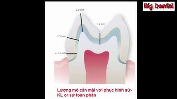 Hướng dẫn mài cùi răng cối lớn hàm trên