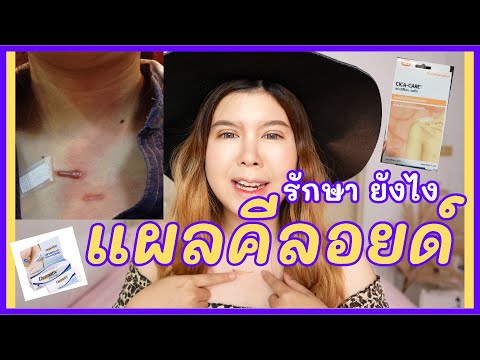 EP.24 แชร์วิธีรักษาคีลอยด์ ไม่ต้องทนเจ็บ คัน ทรมานอีกต่อไป