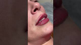 Inst_sophi_inject #lipaugmentation #lips #ტუჩისაუგმენტაცია