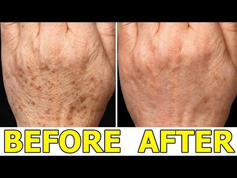 How to Remove Age Spots on Your Hands - 5 Best Ways to Remove Age Spots Naturally