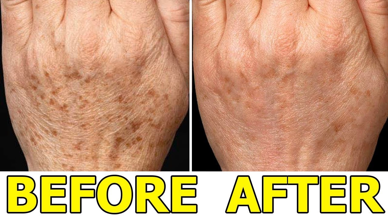How To Remove Age Spots On Your Hands 5 Best Ways To Remove Age Spots