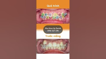 Hành trình LỘT XÁC nhờ niềng răng của Minh Tuyết