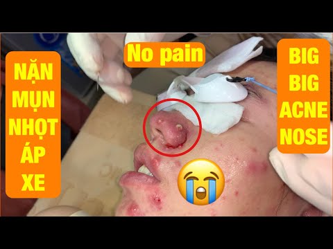 Video Nặn mụn nhọt áp xe đầy mủ vùng mũi nữ bệnh... - youtube