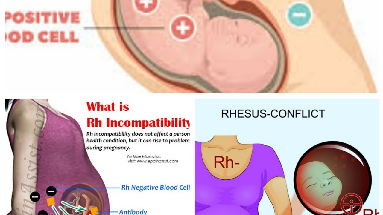 Waruziko Umugore ufite Ubwoko bw'Amaraso budafite Rezisi Atarenza Umwana Umwe gusa
