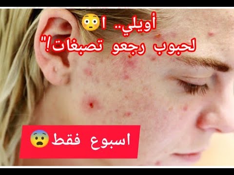 انجح وصفة لازالة الحبوب نهائيا في اسبوع فقط اكسبلور ترند ترند 