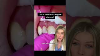 What happens if I don’t floss? #gumdisease #gingivitis #dentist #dentslvideo #floss #flossing