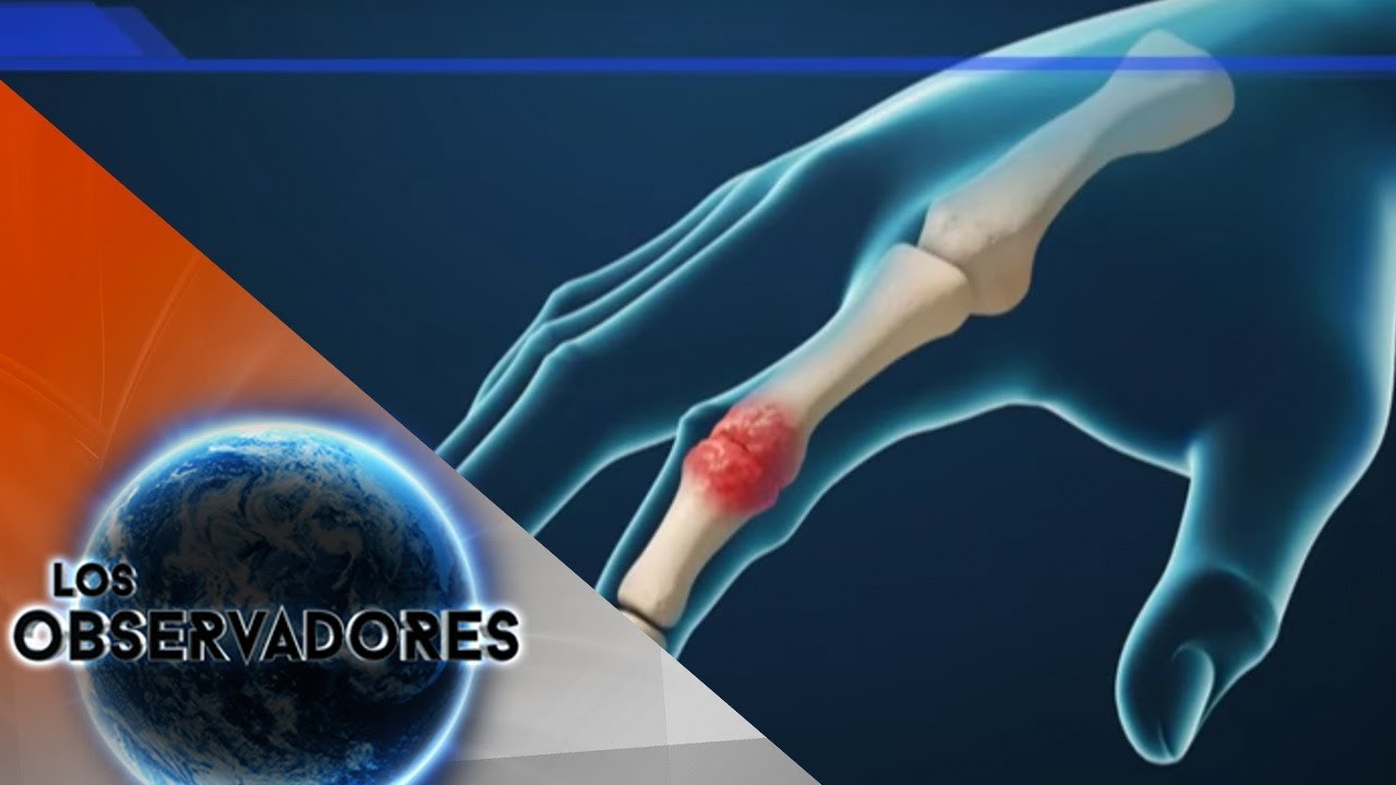 las carnes rojas son malas para la artritis las carnes rojas son malas para la artritis