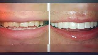 Biscayne Dental Center - Teeth Whitening in Aventura, FL