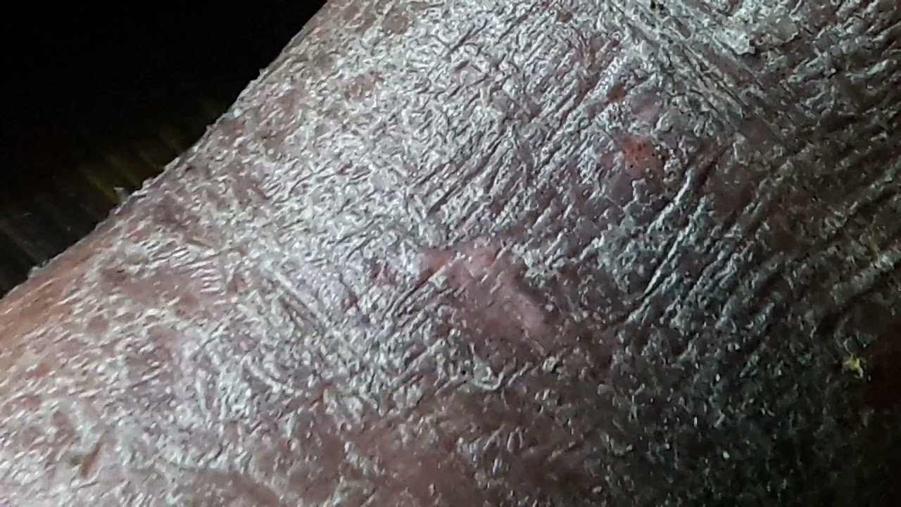 Ulcerated and infected lichenified eczema ankles 