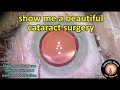 show me a beautiful cataract surgery