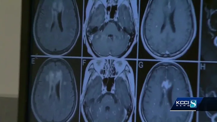 Breakthrough blood test can detect Alzheimer's early