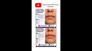 Angular cheilitis notes for USMLE