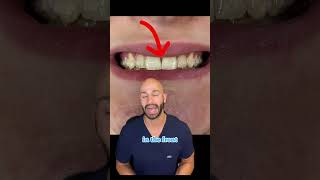 Before Invisalign treatment, and 5-month progress. 2023