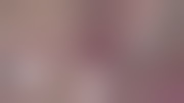 Laparoscopic Right Hepatectomy