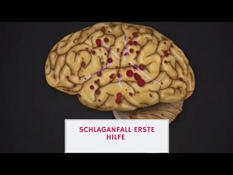 Schlaganfall erste Hilfe vor Ankunft auf der Stroke Unit