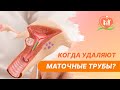 👉 Когда удаляют маточные трубы?