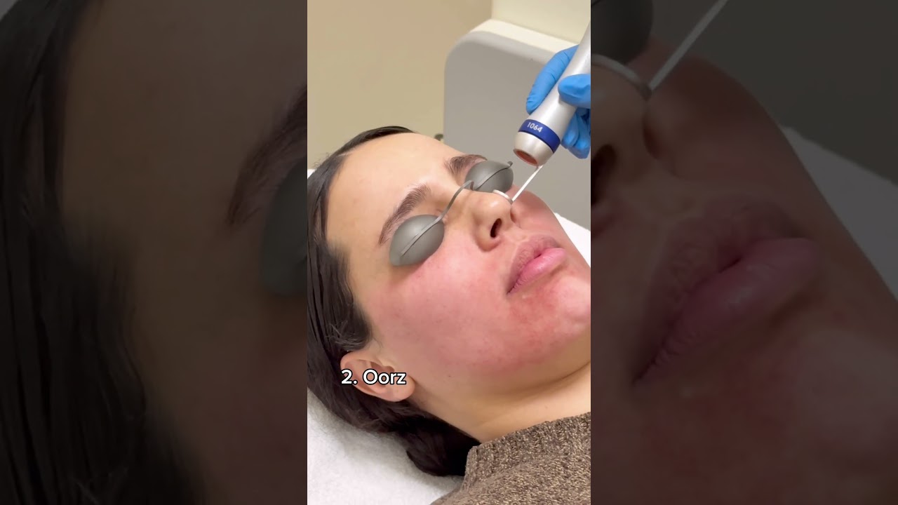 Pigment laser , voor alle soorten pigmentatie en alle huidtypes!