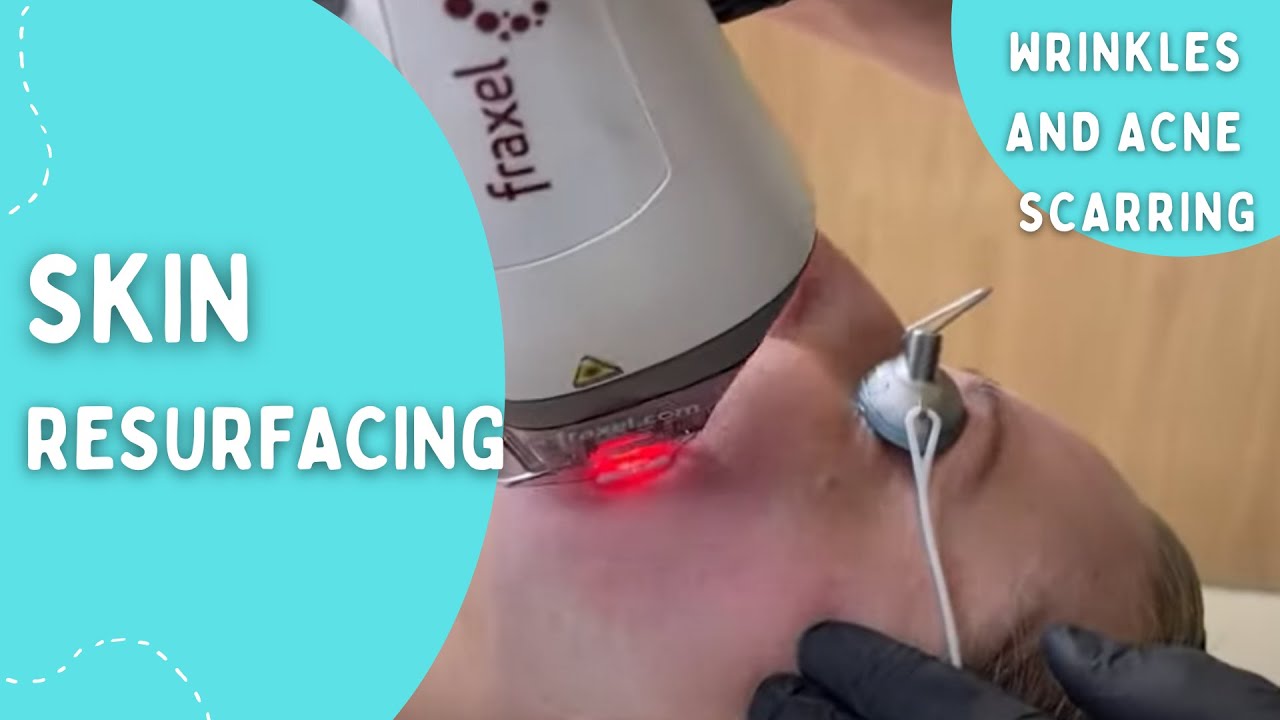 FRAXEL DUAL FOR SKIN RESURFACING OF FINE LINES. WRINKLES AND ACNE SCARRING | DR JASON EMER