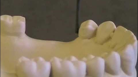 03 Selecting a Path of Insertion & Tripoding