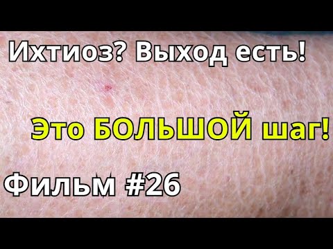 Ихтиоз? Выход есть! Фильм#26. Это БОЛЬШОЙ шаг!