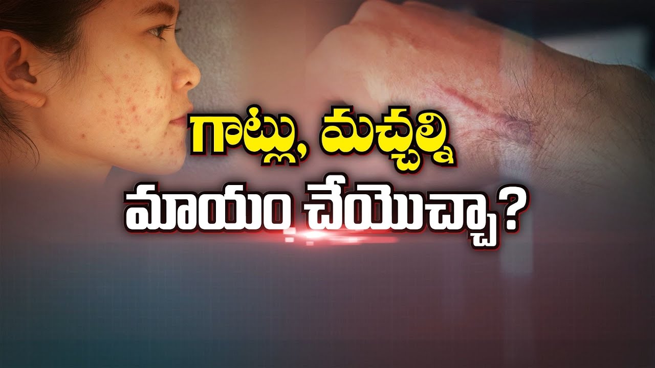 గాట్లు, మచ్చల్ని మాయం చేయొచ్చా ? | Management of Scars | Sukhibhava | ETV Life