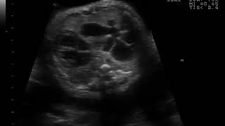 Makp, Forme Macrokystique