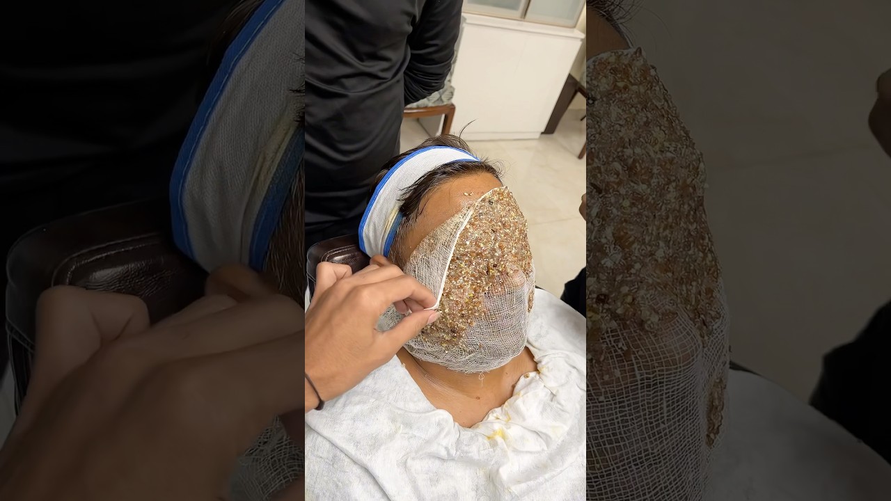 Who know this treatment ?💀🤡.