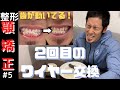 【顎変形症#5】歯科矯正-２回目のワイヤー交換-歯が動いてる！【顎矯正手術をやってみる。歯科矯正日記～顎切りまでの道のり】