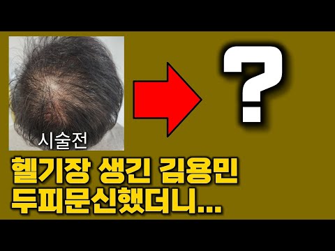 김용민 두피문신 체험기... 부작용은? 탈모개선은? [광고]