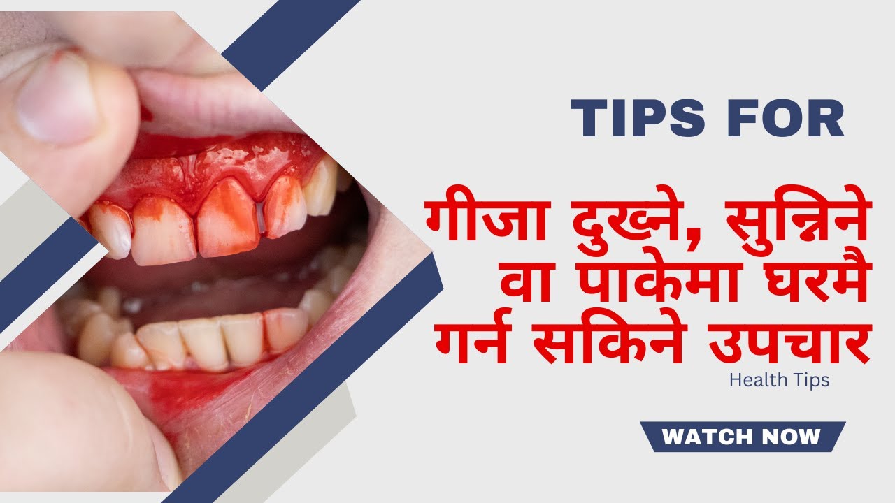 गीजा दुखेमा, सुन्निएमा वा पाकेमा घरमै गर्न सकिने उपचार || Home Treatment for Gum( Teeth) Disease