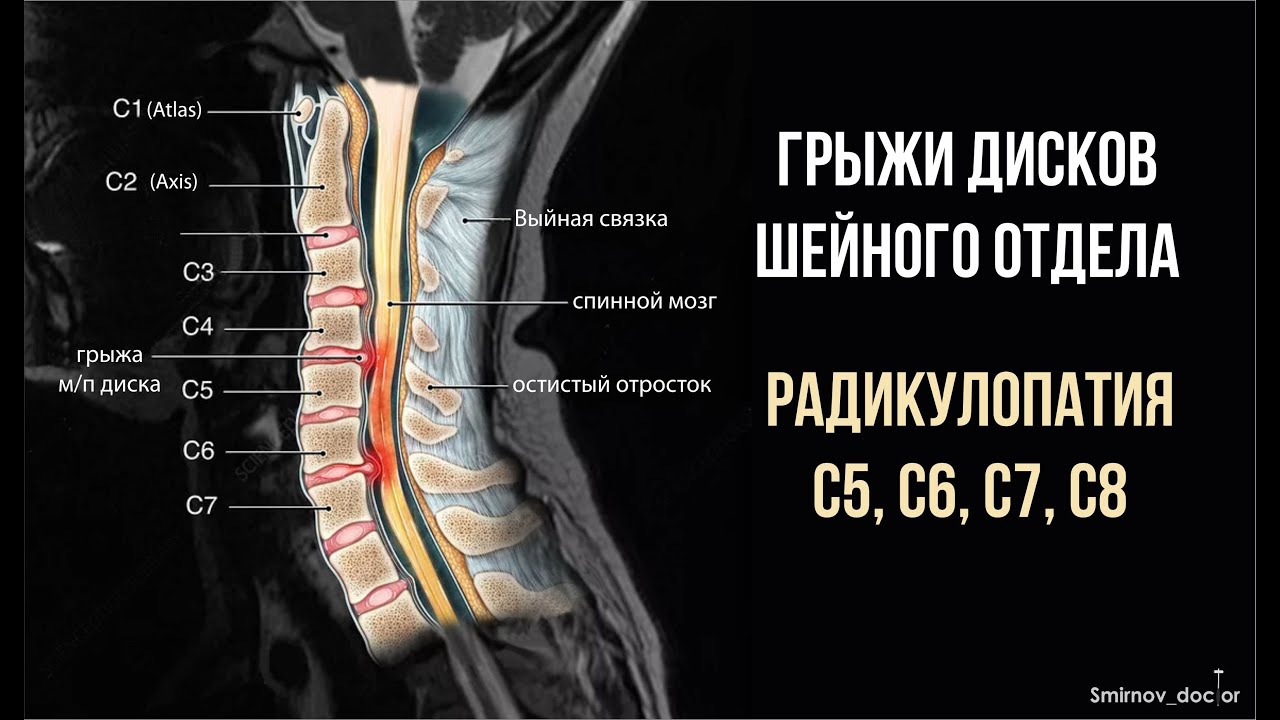 Лечение грыжи шейного отдела без операции