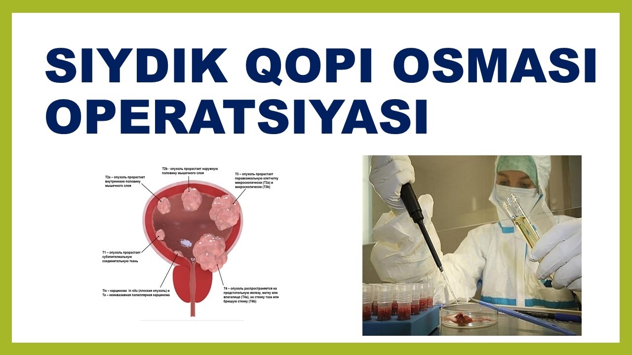 SIYDIK QOPI RAKI OPERATSIYASI