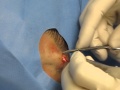 Cyst removal by cutting it out