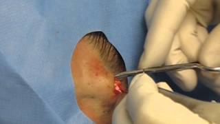 Download lagu Cyst Removal by cutting it out Cyst Removal by cutting it out