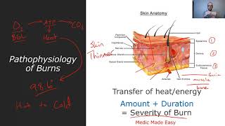 Burns - Pathophysiology, Rule of 9's, and Parkland Formula fluid resuscitation