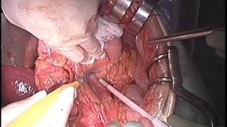 Total gastrectomy with spleno-pancreatectomy for  advanced carcinoma of esophago-gastric junction