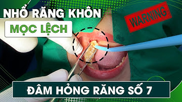Kịp Thời Nhổ 2 Răng Khôn Mọc Lệch - Cố Gắng Giữ Lại Răng Số 7