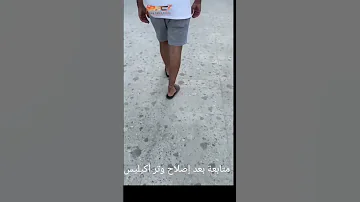 قطع وتر أكيليس اربع شهور من العملية هل المريض يمشي طبيعي 