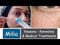 Milia - Homemade Pack से ठीक नही होगा | Reasons, Remedies & Medical Treatments