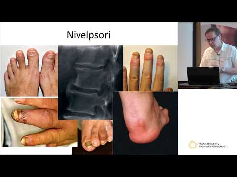 Video: Sukupuolielinten Psoriasis: Oireet, Hoito Ja Paljon Muuta