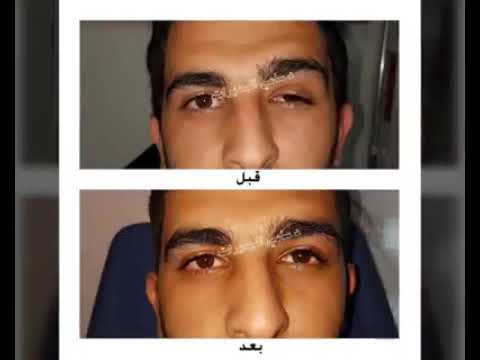 نزول الجفن الخلقي عملية رفع الاجفان