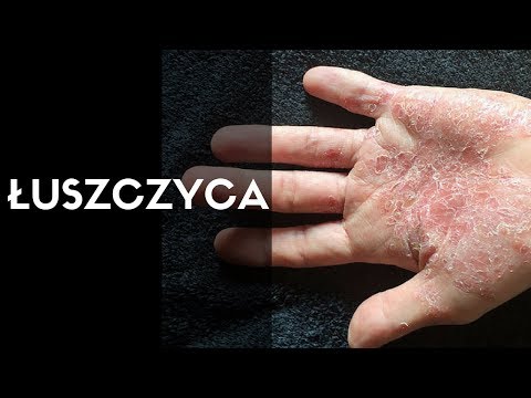 Dermatolog mówi o: ŁUSZCZYCA