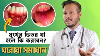 মুখের ঘা বা আলসার থেকে মুক্তির সহজ উপায় | Mouth Ulcer Treatment | Dr Muntasir Mahbub screenshot 5