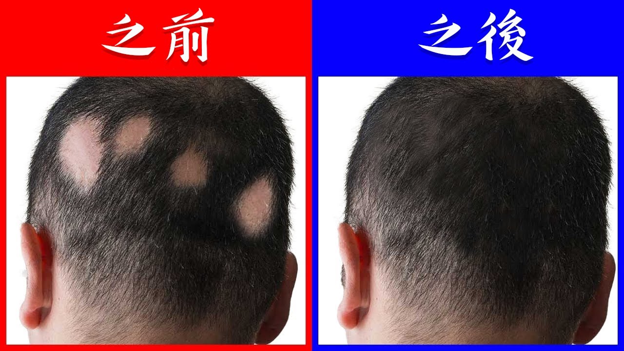 圓形禿脫髮要吃3種微量礦物質,自然療法,柏格醫生 Dr Berg